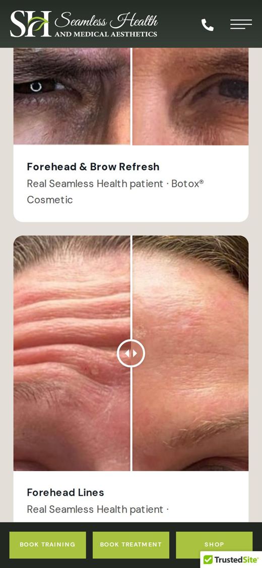 Seamless Health Botox page on a phone: Real results, drag to compare